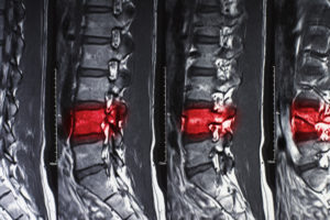 Spinal Cord Injuries