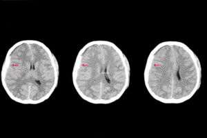 traumatic brain injury