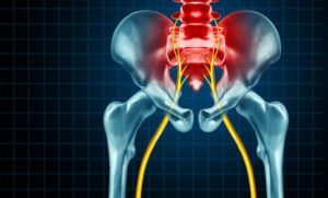 5 Ways to Get Relief from Sciatica