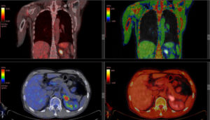 PET Scan
